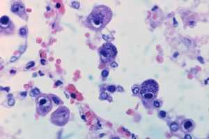 Что такое – цитомегаловирус