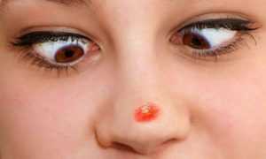 Причины появление герпеса в носу