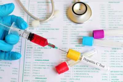 Вирусная нагрузка при гепатите С - как проводятся тесты