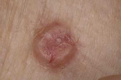 Рак кожи - виды, симптомы и возможности лечения