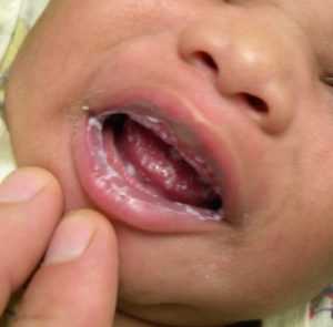 Что такое – кандидоз у малыша во рту