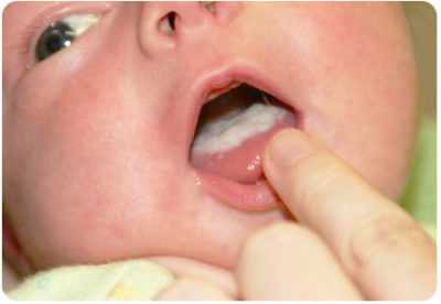 Молочница у новорожденных во рту - причины, симптомы и лечение