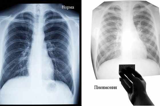 Рентген легких 