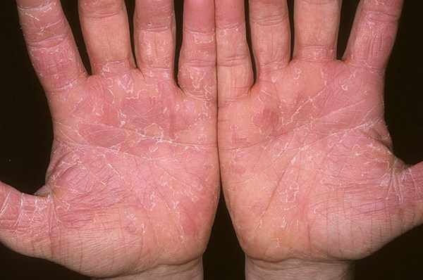 Синдром ошпаренной кожи