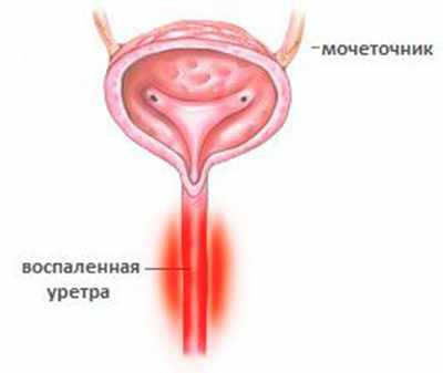 Воспаление уретры у женщин
