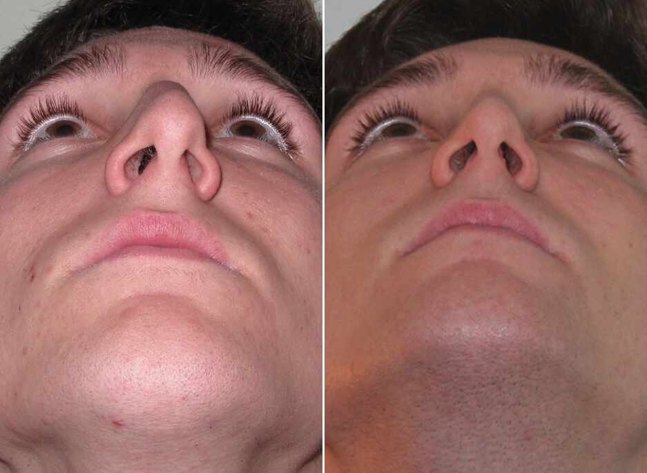Симптомы клебсиеллы в носу