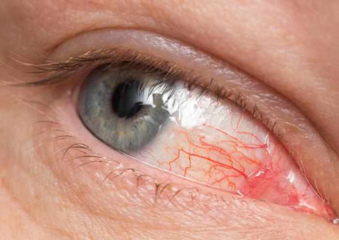 Клинические особенности токсоплазмоза глаз