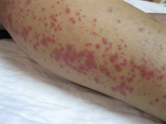 Сильные покраснения кожи — один из симптомов лептоспироза