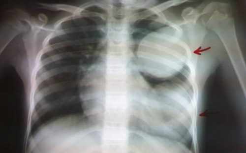 Клиническая картина аскаридозного поражения лёгких