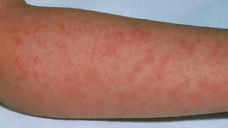 Стафилококковая инфекция кожи