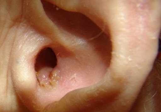 Золотистый стафилококк в ухе