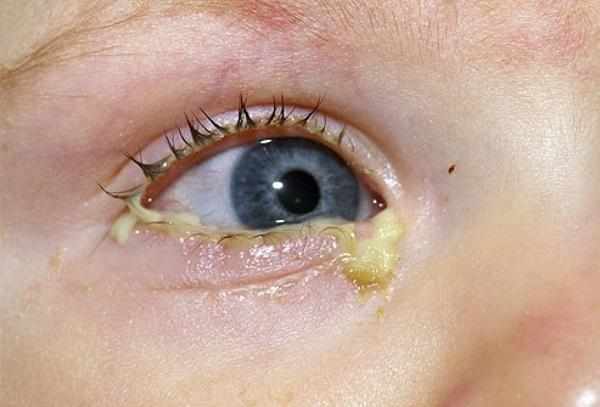 Инфекции лор-органов и глаз