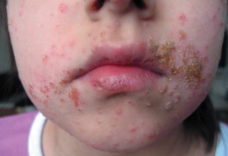 Стафилококковая инфекция на коже лица