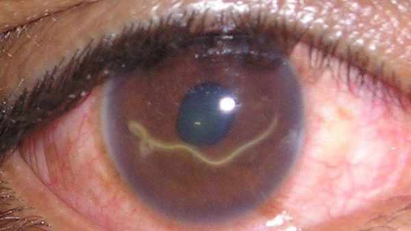 Симптомы глазного токсокароза