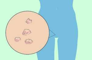 Причины появления волдырей на половых губах у женщин. На какие симптомы следует обратить внимание и обратиться за диагностикой, чтобы своевременно начать выбрать метод лечения белых пузырьков на половых органах.