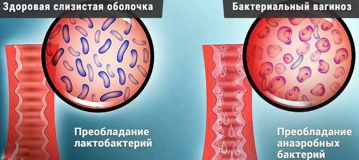 Бактериальный вагиноз