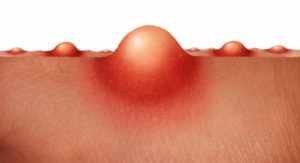 Гнойник на половой губе: причины фурункулов на малых и больших губах