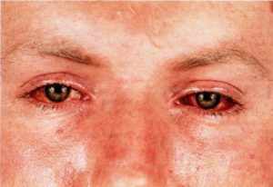 Хламидиоз глаз (хламидийный конъюнктивит)