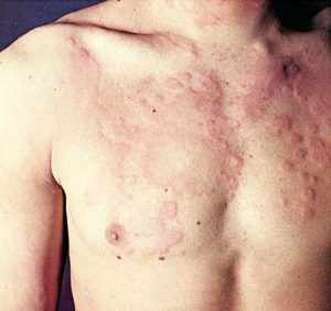 Проявление аллергических реакций при ВИЧ