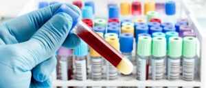 Показатели общего анализа крови при вич-инфекции и их расшифровка