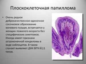 папилломы плоскоклеточная