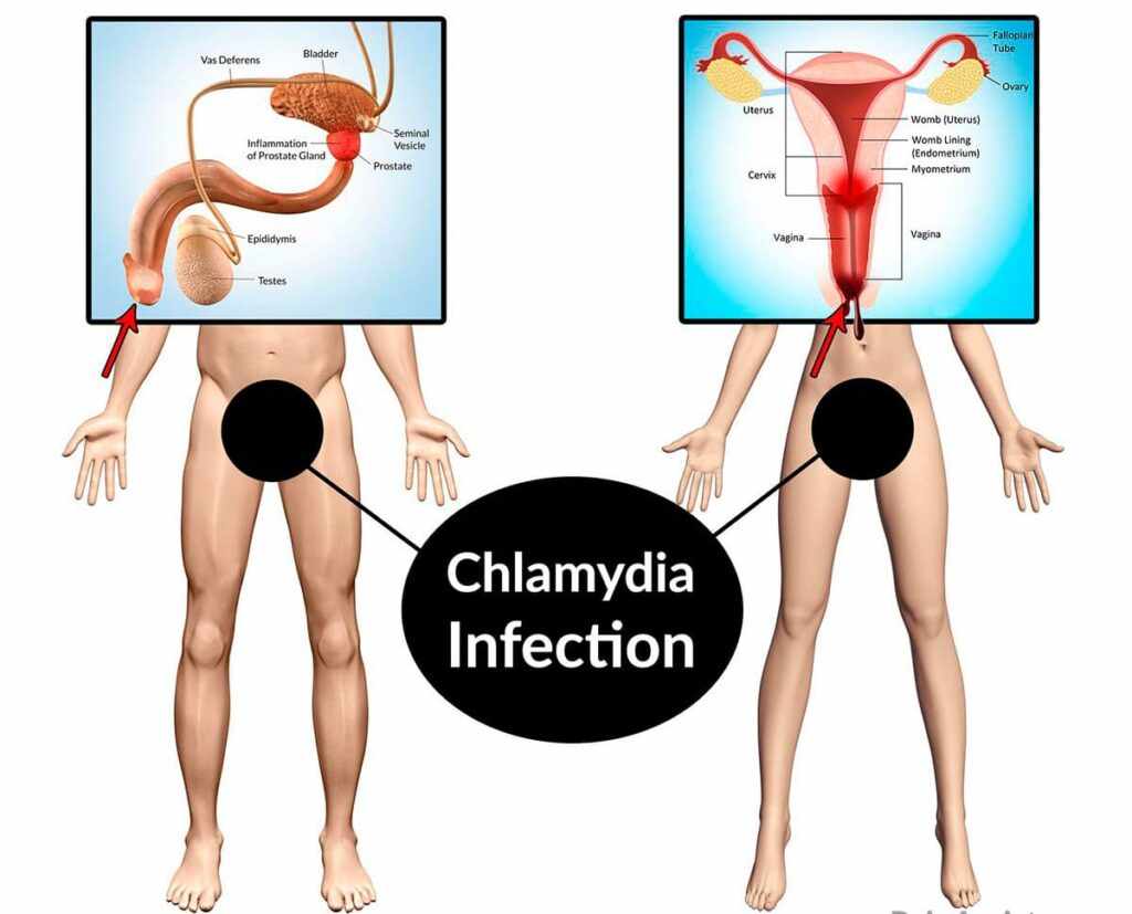 Как передается хламидийная инфекция