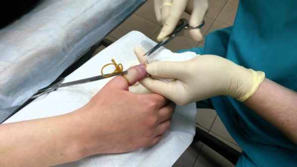 Хирургическое лечение нарыва на пальце