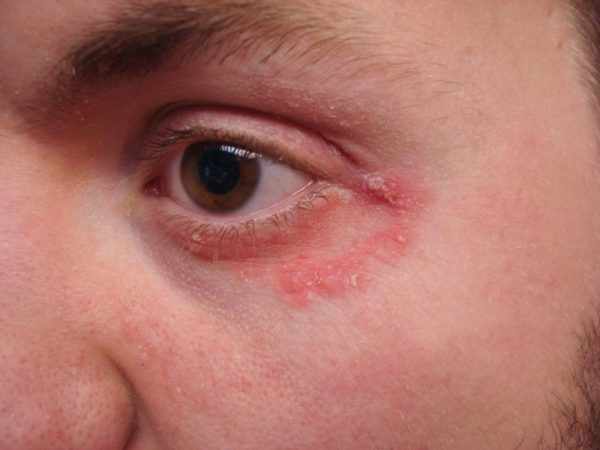Атопический глазной дерматит