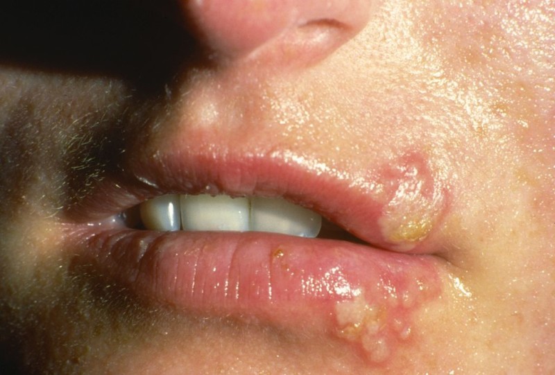 При обострении герпесвирусной инфекции нужно повременить с удалением невуса