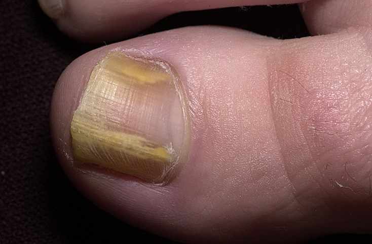 Дистальный грибок на ногтях