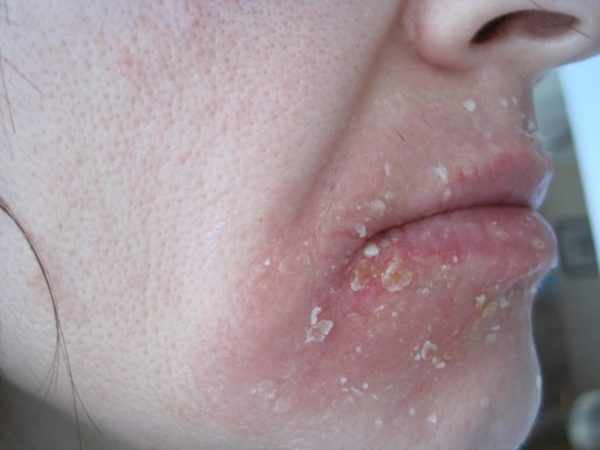 Себорейный дерматит на лице