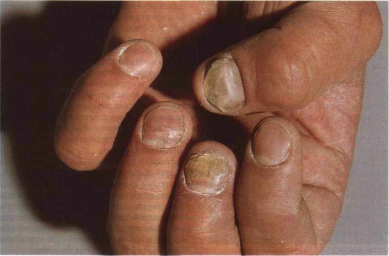 Распространение грибка может привести к полной потере ногтя