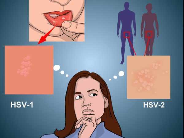 Herpes simplex virus 