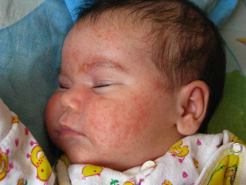 Как выражается пиодермия у ребенка, лечение опасной инфекции