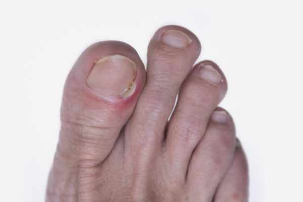 Симптомы и внешний вид вросшего ногтя
