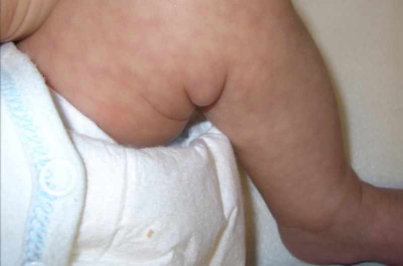 Мраморная сетка у младенца