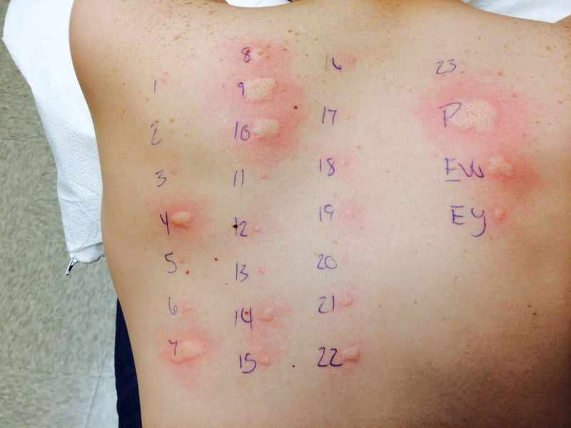 Метод накожных аллергических проб