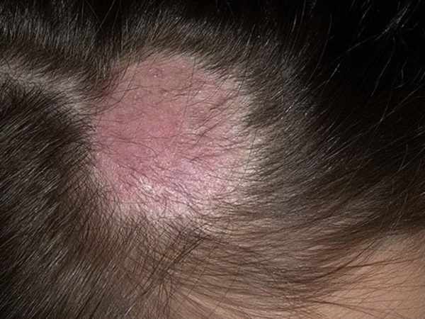 Микроспория волосистой части головы