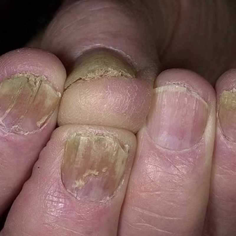 Микроспория ногтей