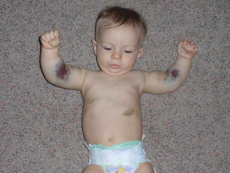 Тромбоцитопеническая пурпура у ребенка