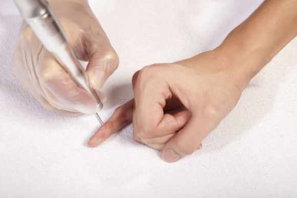 Методы выведения бородавок у ребенка на пальцах