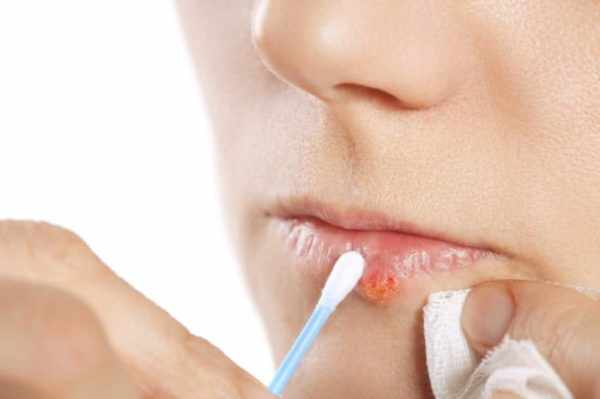 Эффективна ли тетрациклиновая мазь для лечения вируса герпеса на губах