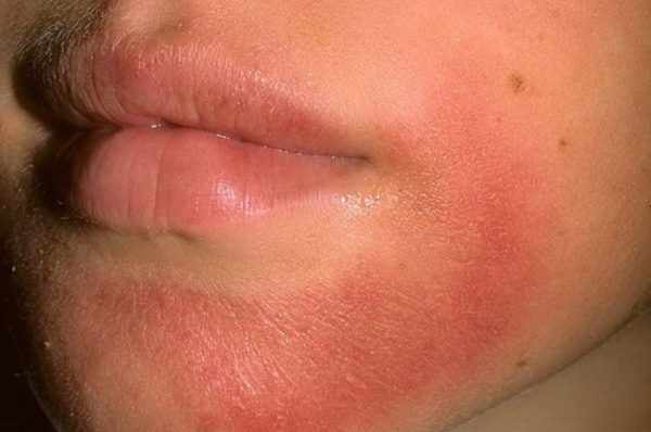 Аллергия на лице