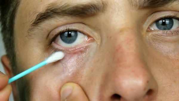 Диагностика демодекоза глаз