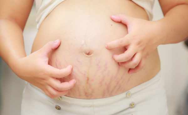 Зуд при беременности вследствие растяжек