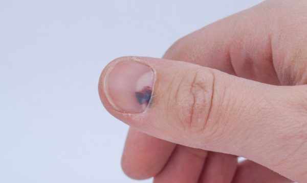 Темное пятно на ногте - первый симптом развития рака ногтей