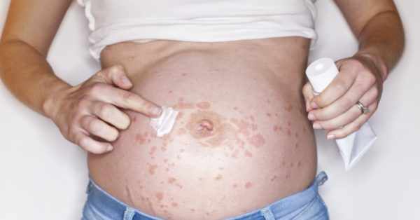 Лечение псориаза при беременности