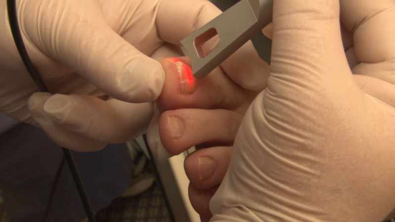 Лазерная терапия ногтевого грибка